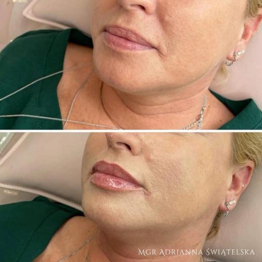 Metamorfoza przed i po — 53