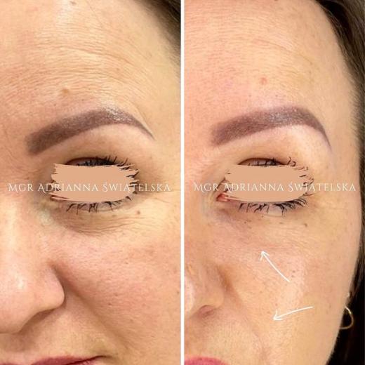 Metamorfoza przed i po — 39