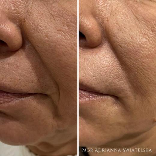 Metamorfoza przed i po — 47