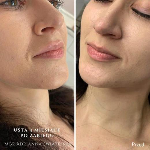 Metamorfoza przed i po — 25