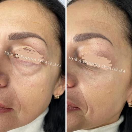 Metamorfoza przed i po — 50