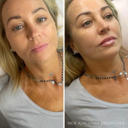 Metamorfoza przed i po — 44