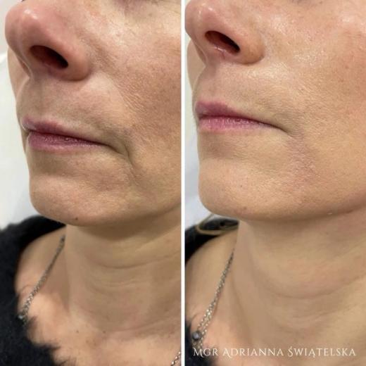 Metamorfoza przed i po — 40