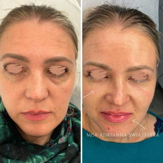 Metamorfoza przed i po — 29