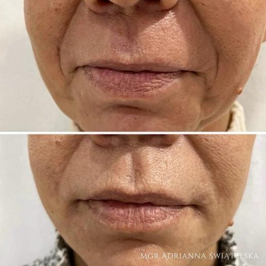 Metamorfoza przed i po — 48