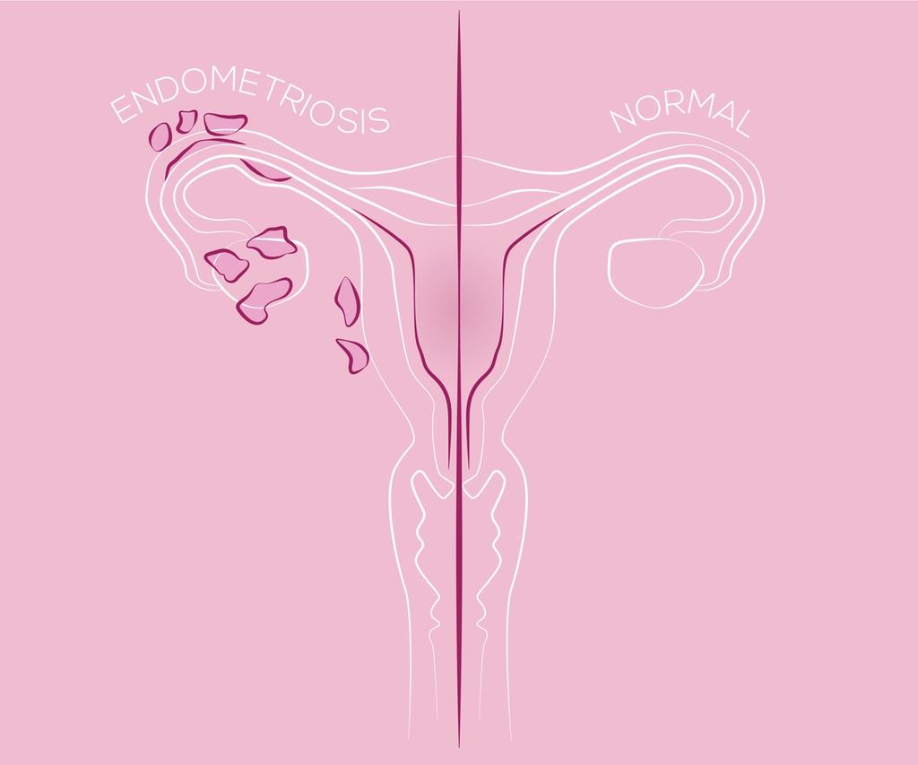Tegning av en normal livmor og livmor med endometriose
