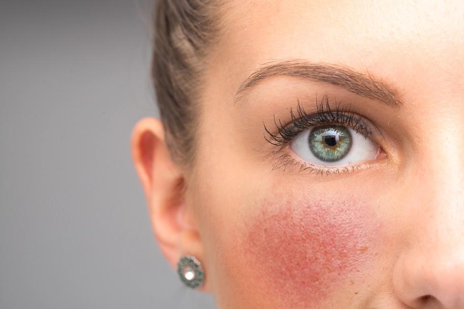 Hva Er Rosacea Og Hvordan Bli Kvitt Det Maja hva-er-rosacea-og-hvordan-bli-kvitt-det-maja