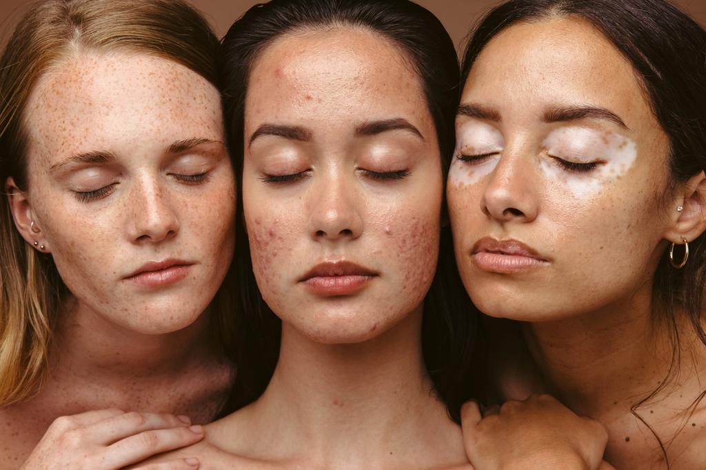 Bilde av ansiktene til tre kvinner med ulik hudtilstand