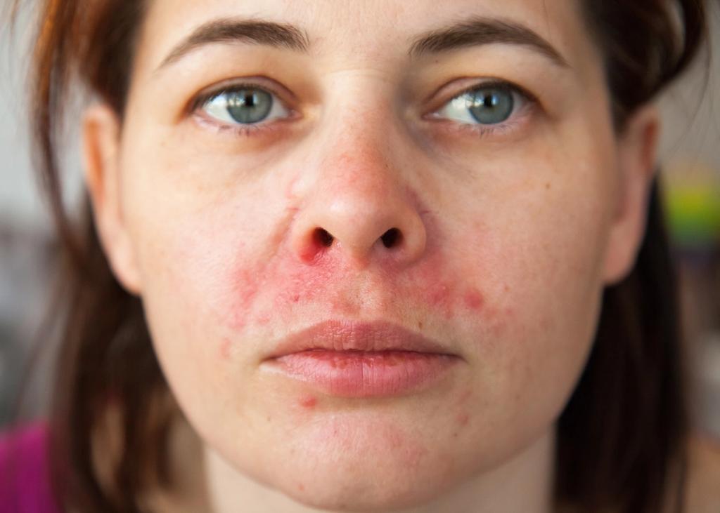 kvinne med perioral dermatitt, utslett rundt munn