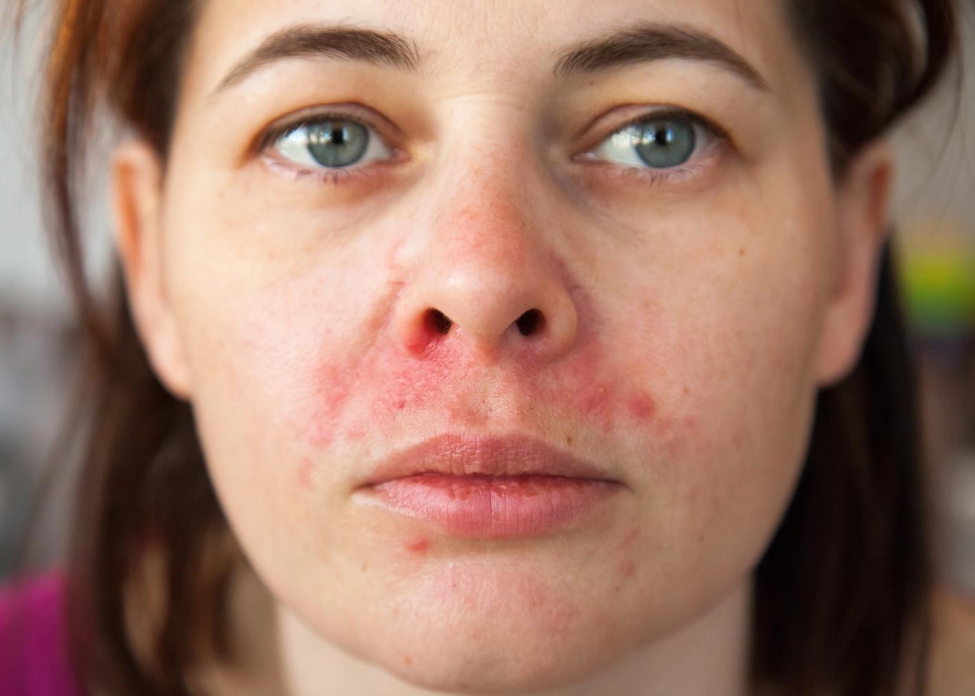 Hva Er Perioral Dermatitt Maja
