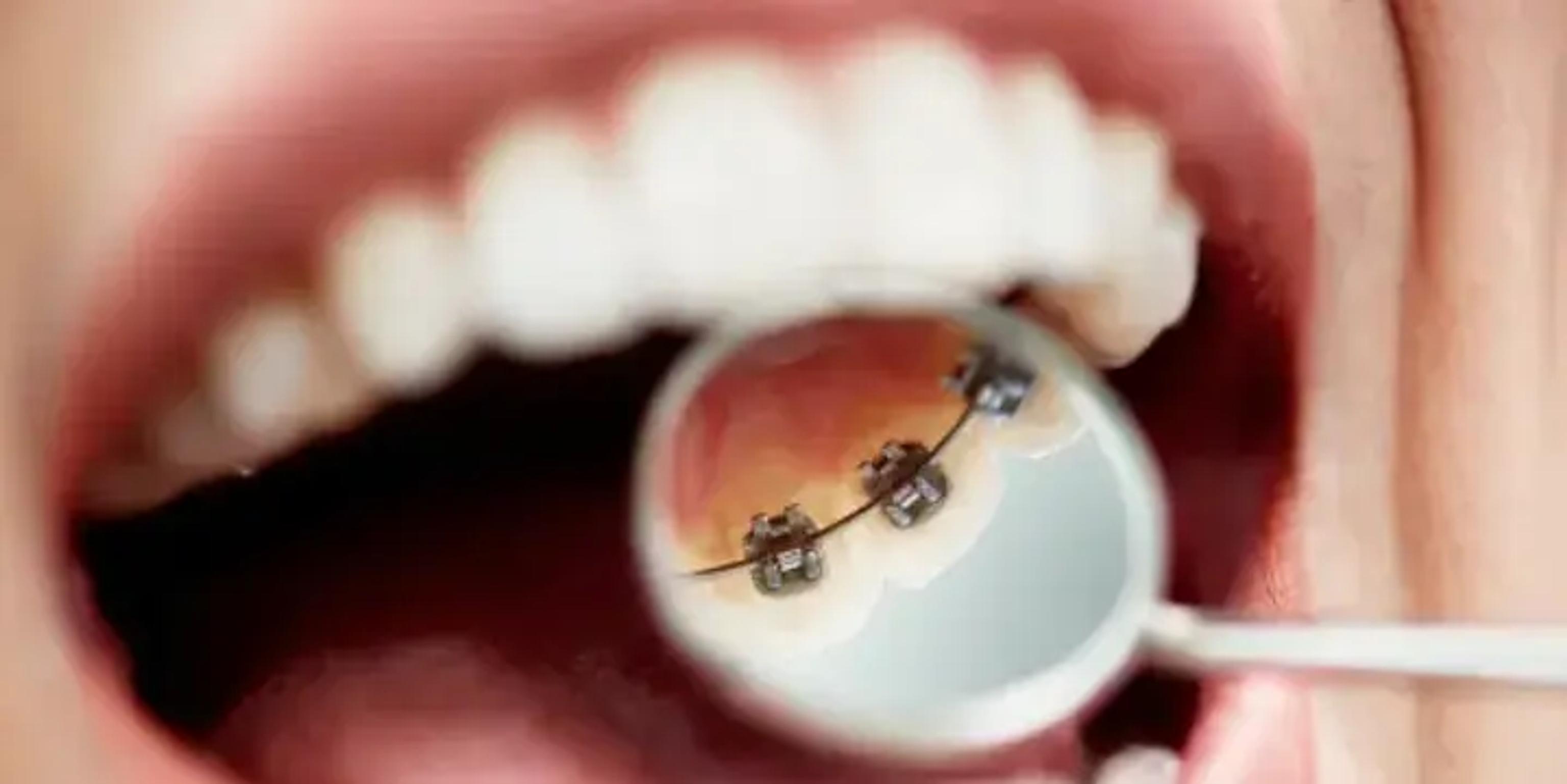 Lingualzahnspange an der Innenseite der Zähne