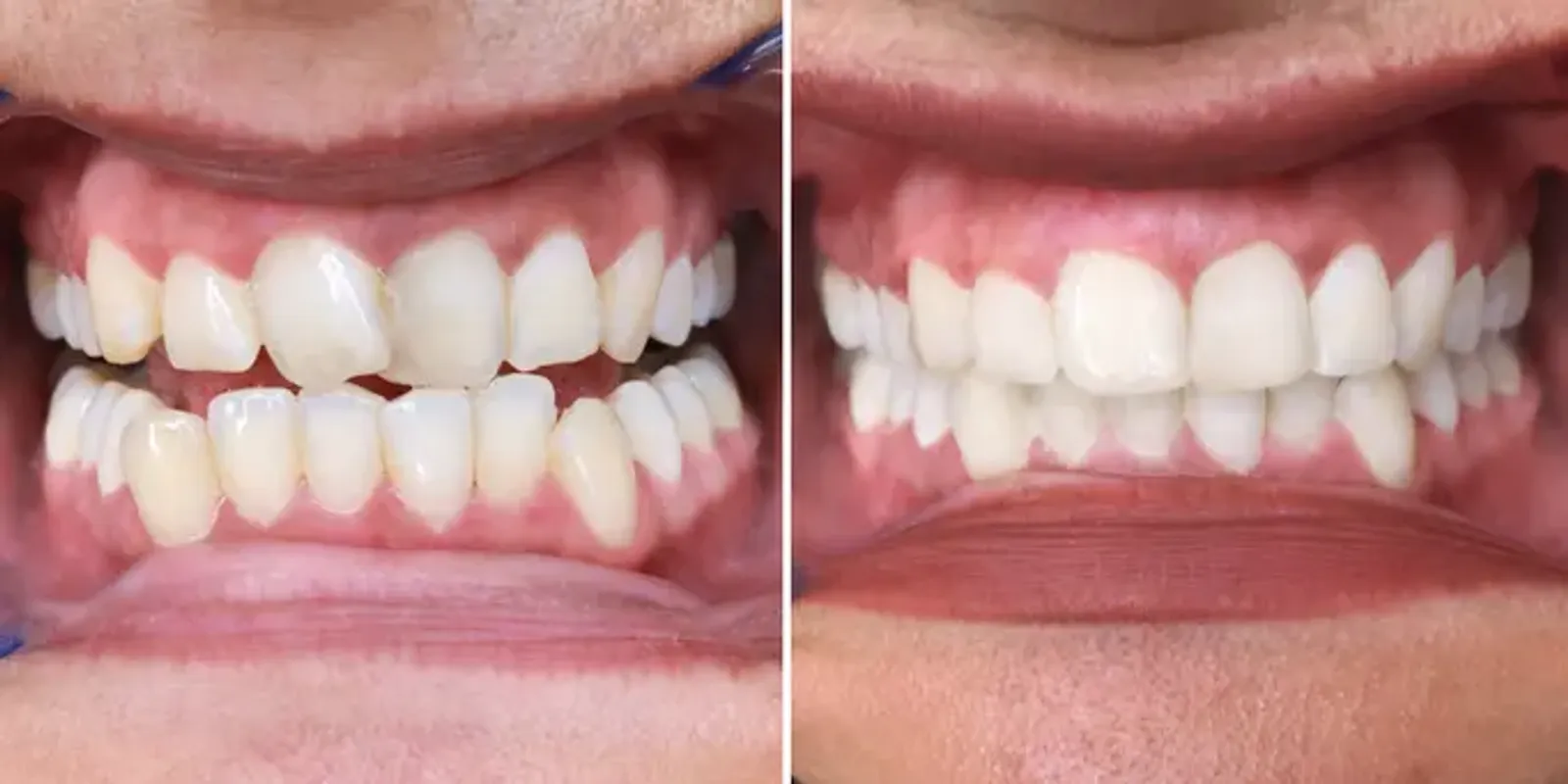 Vergleich von schiefen Zähnen vorher und nachher