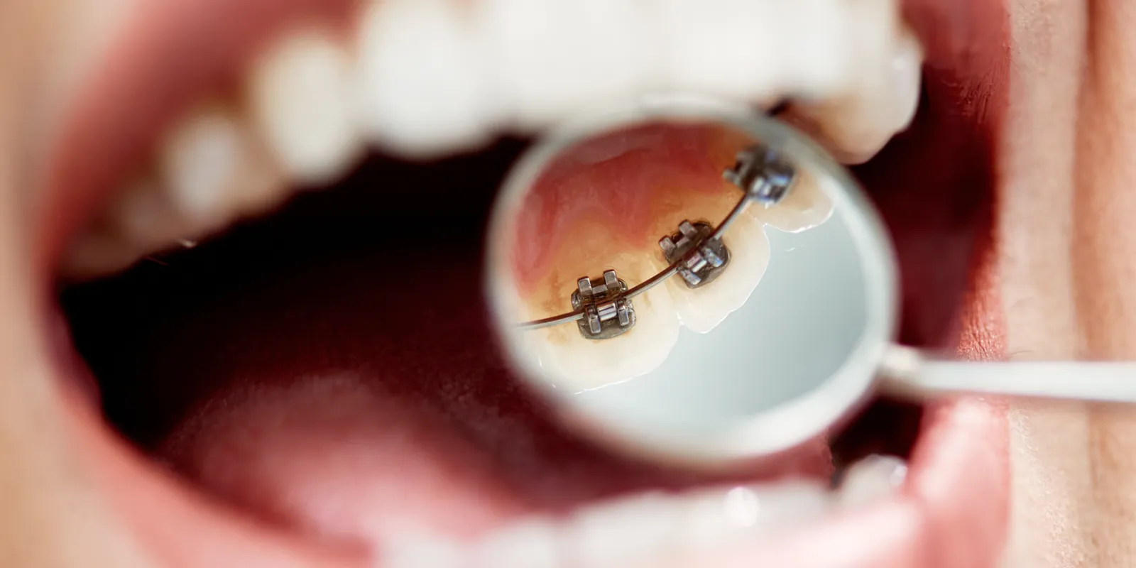 Linguale Zahnspange Illustration