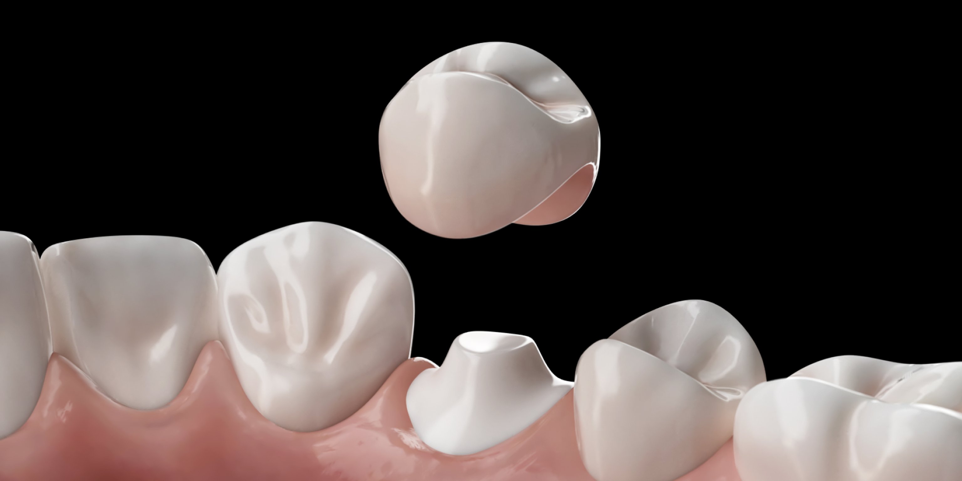 Zahnkrone vs Veneers Vergleich