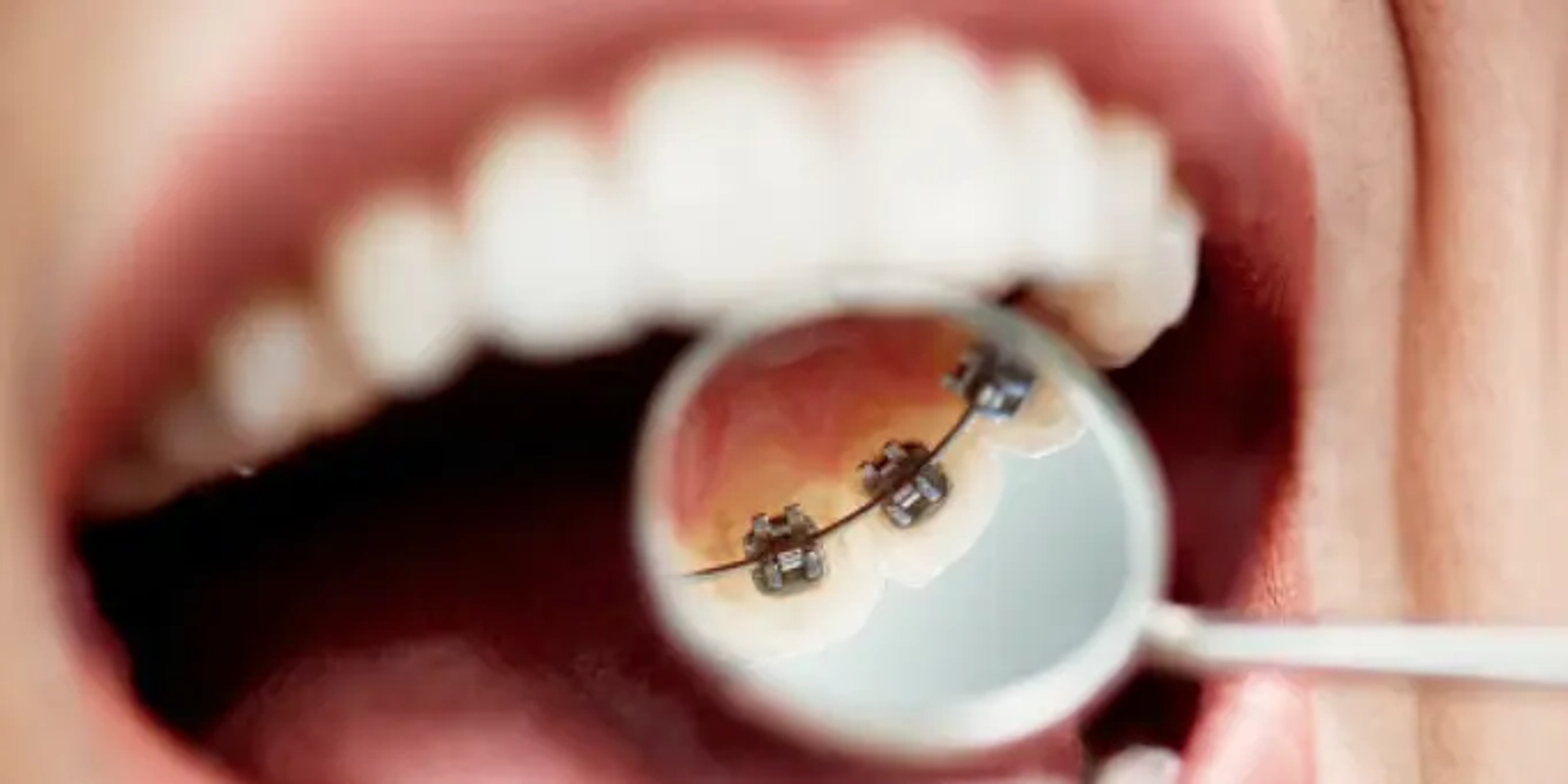 Festsitzende Zahnspange mit Brackets