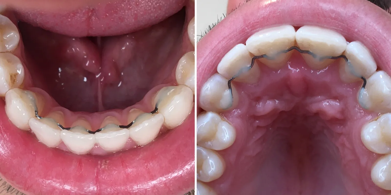 Draht-Retainer für Zahnstabilisierung