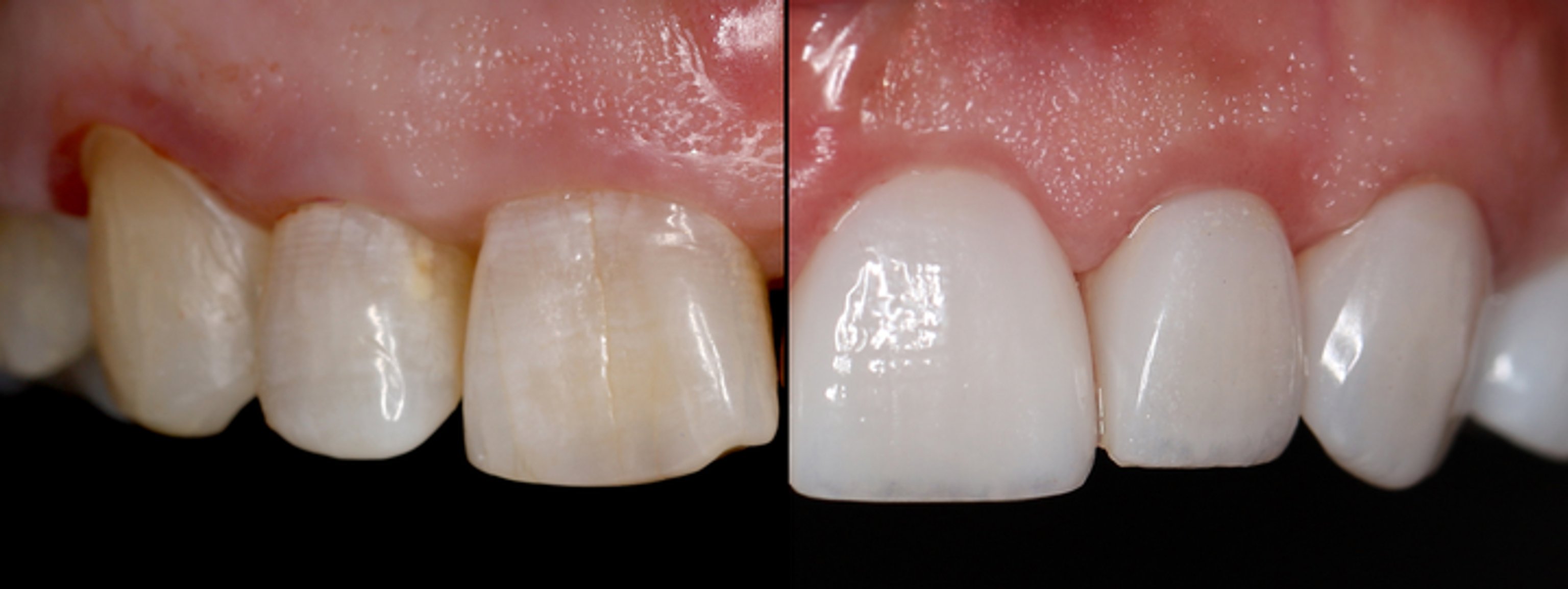 Before and after gum lift comparison