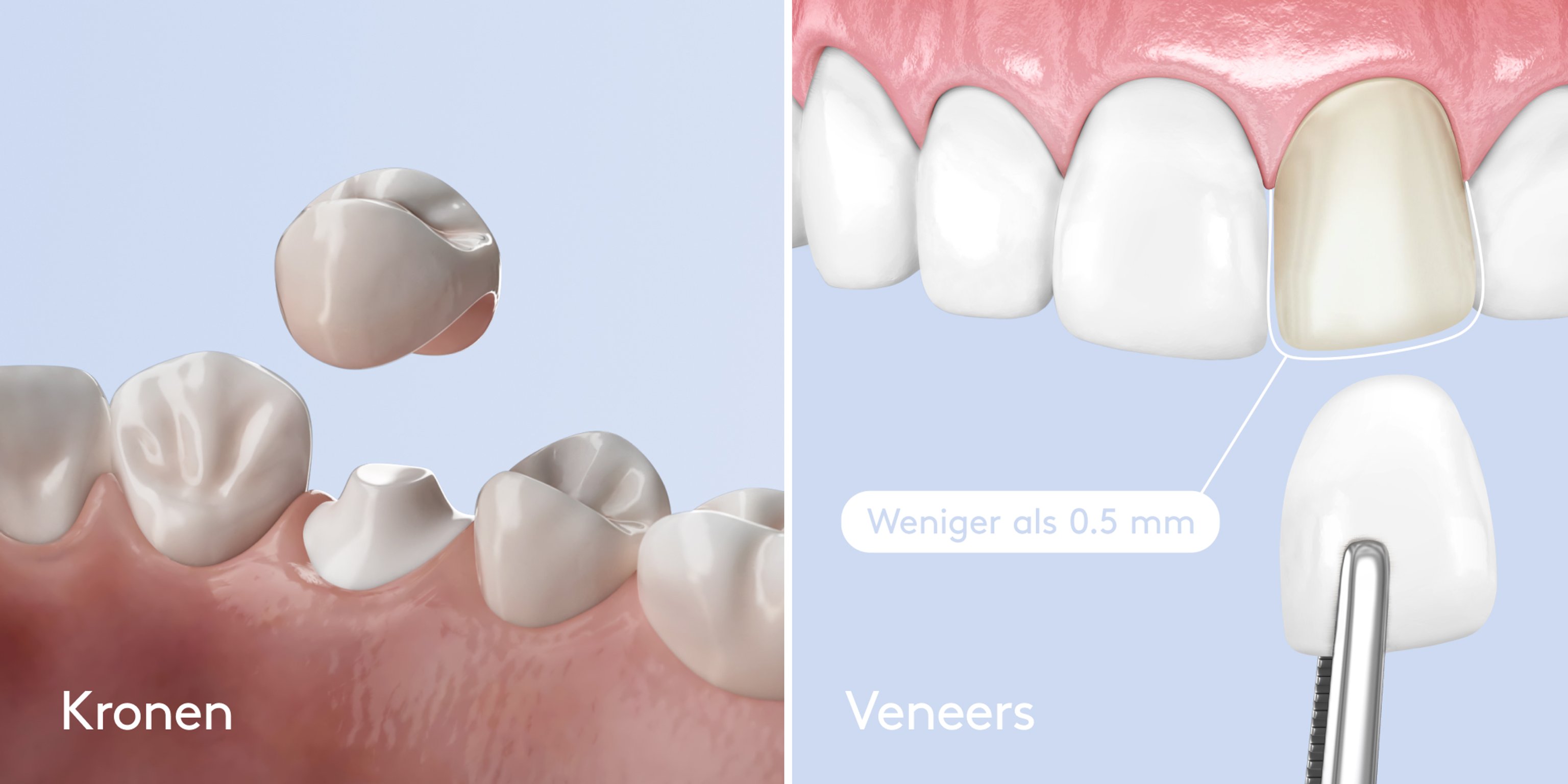 Vergleich zwischen Kronen und Veneers