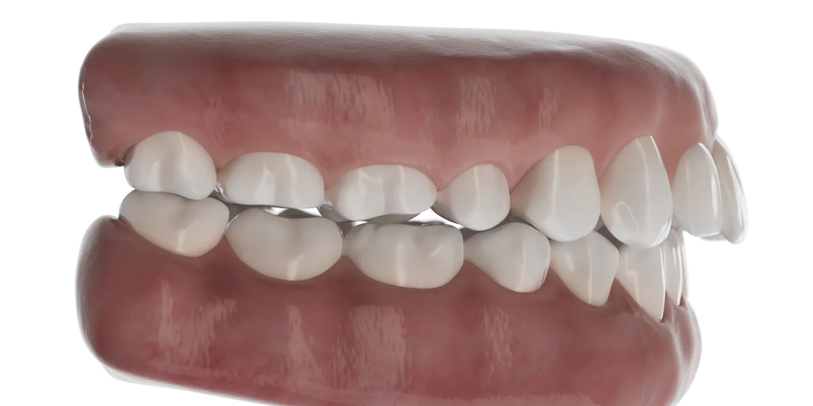 Illustration eines Überbisses