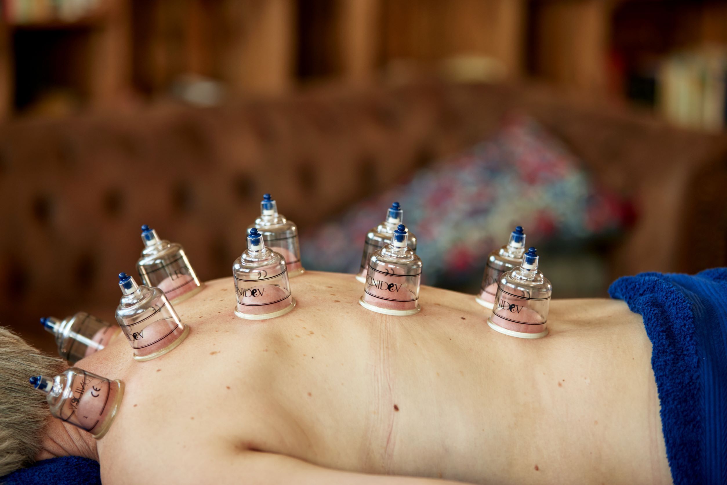 Schröpfgläser auf dem Rücken eines Mannes