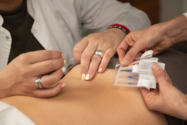 An In-Depth Guide to How Dry Needling Works and Its Benefits