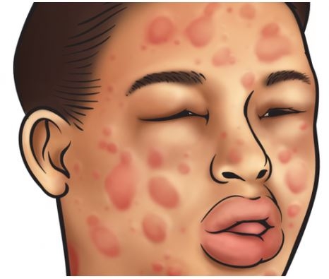 Triệu chứng bị dị ứng đậu phộng