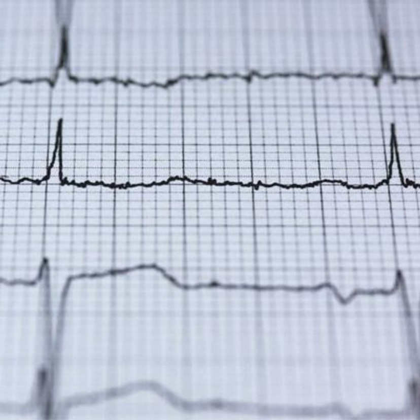 zoomed in ekg transcription