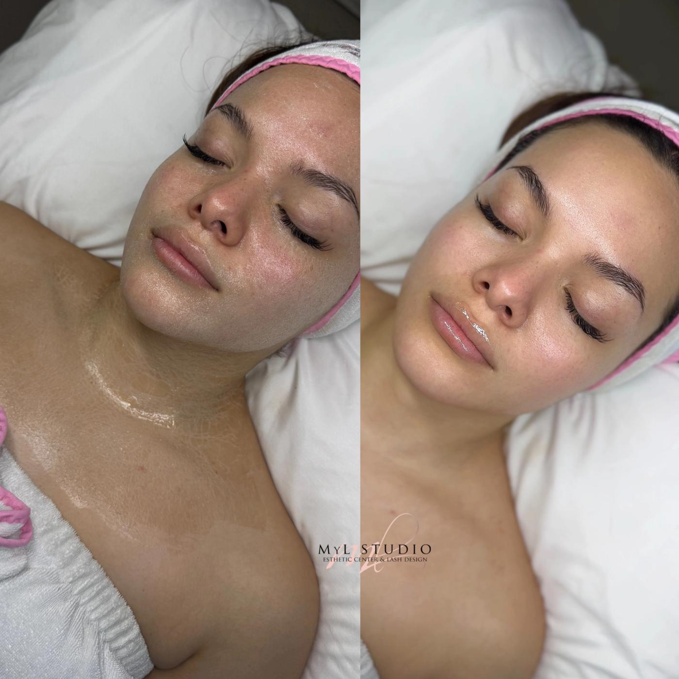 Rejuvenecimiento facial