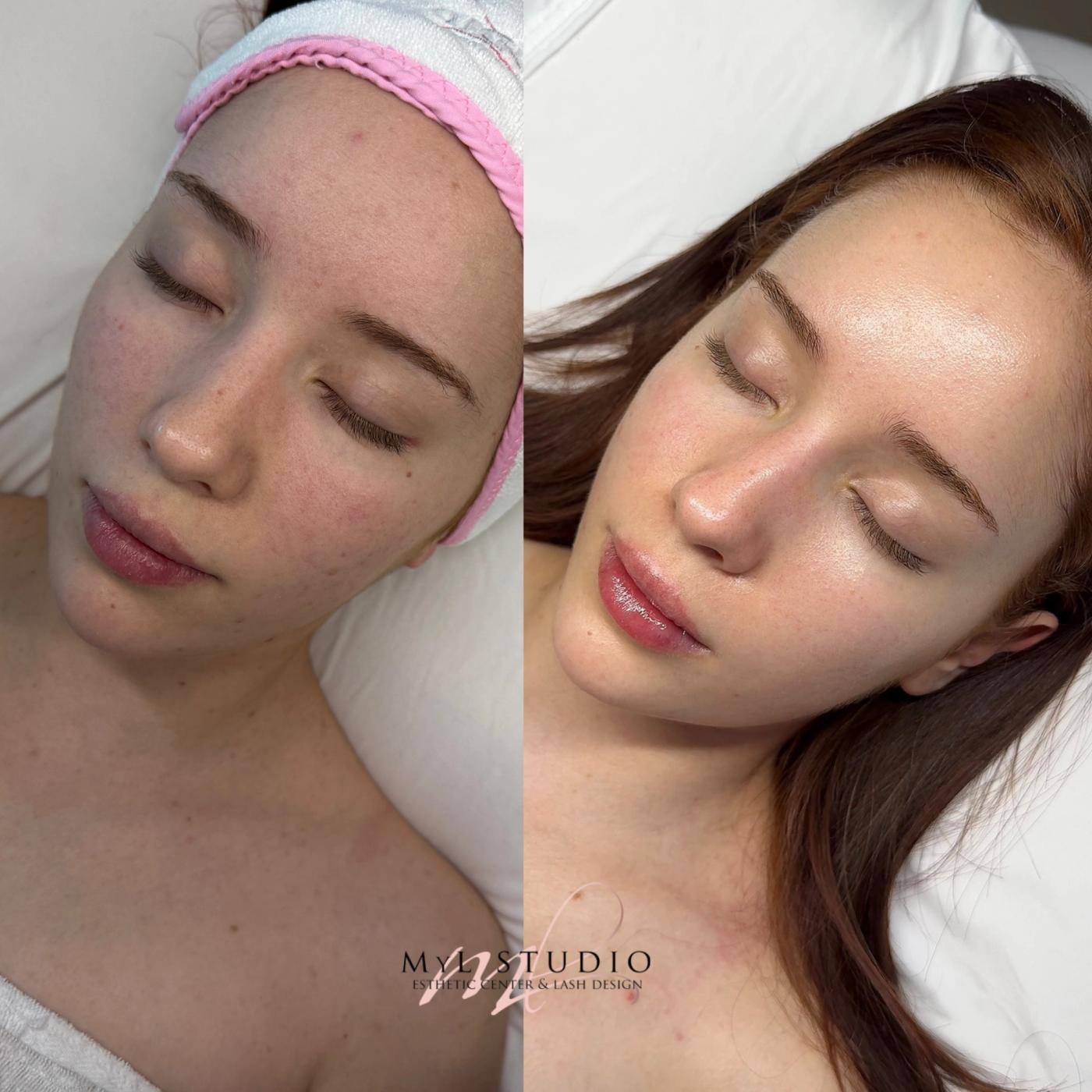 Rejuvenecimiento facial