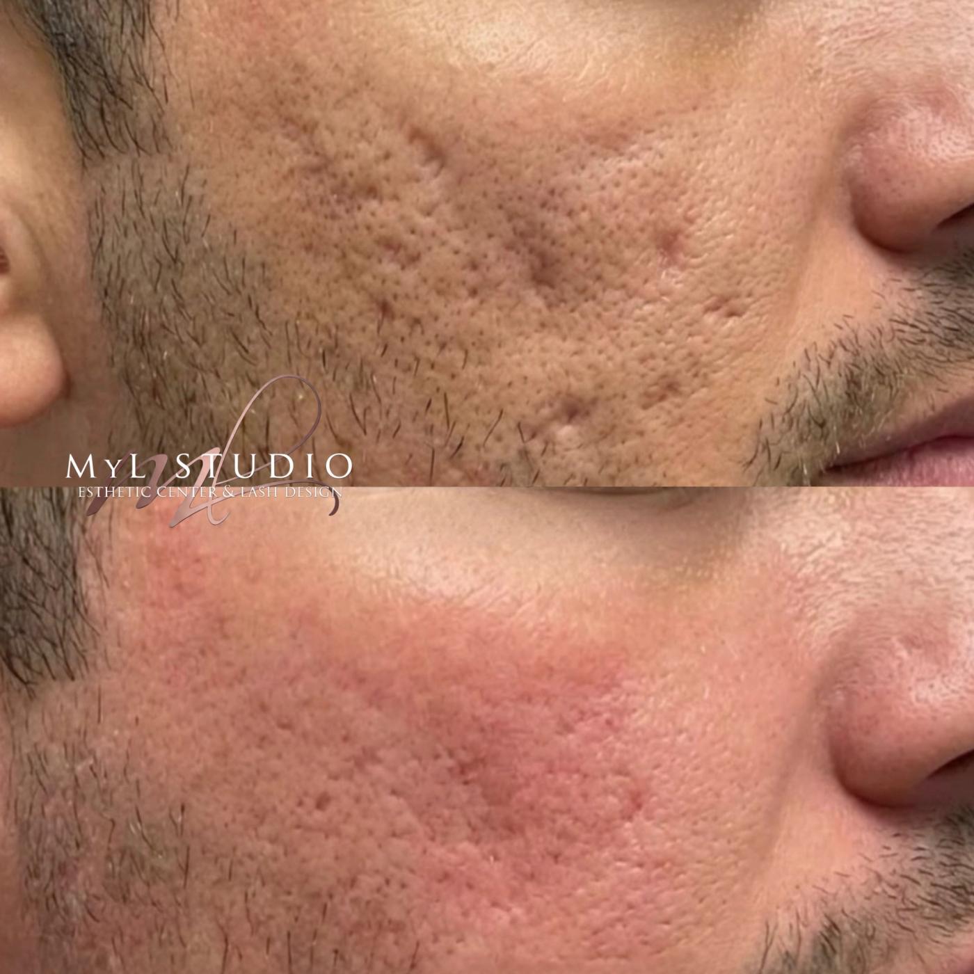 Rejuvenecimiento facial