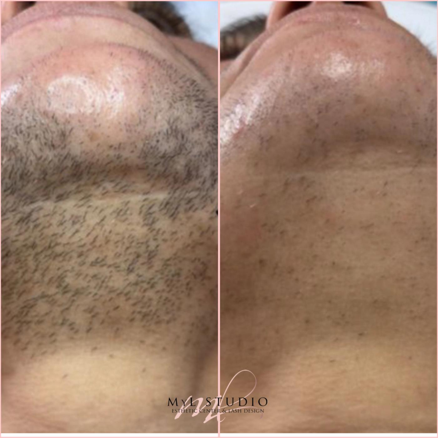 Rejuvenecimiento facial