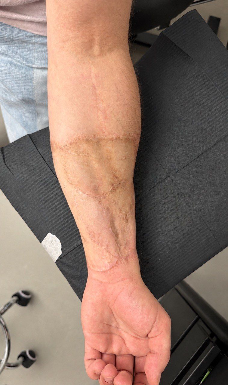 Unterarm mit großflächigen Narben vor dem Cover-up-Tattoo