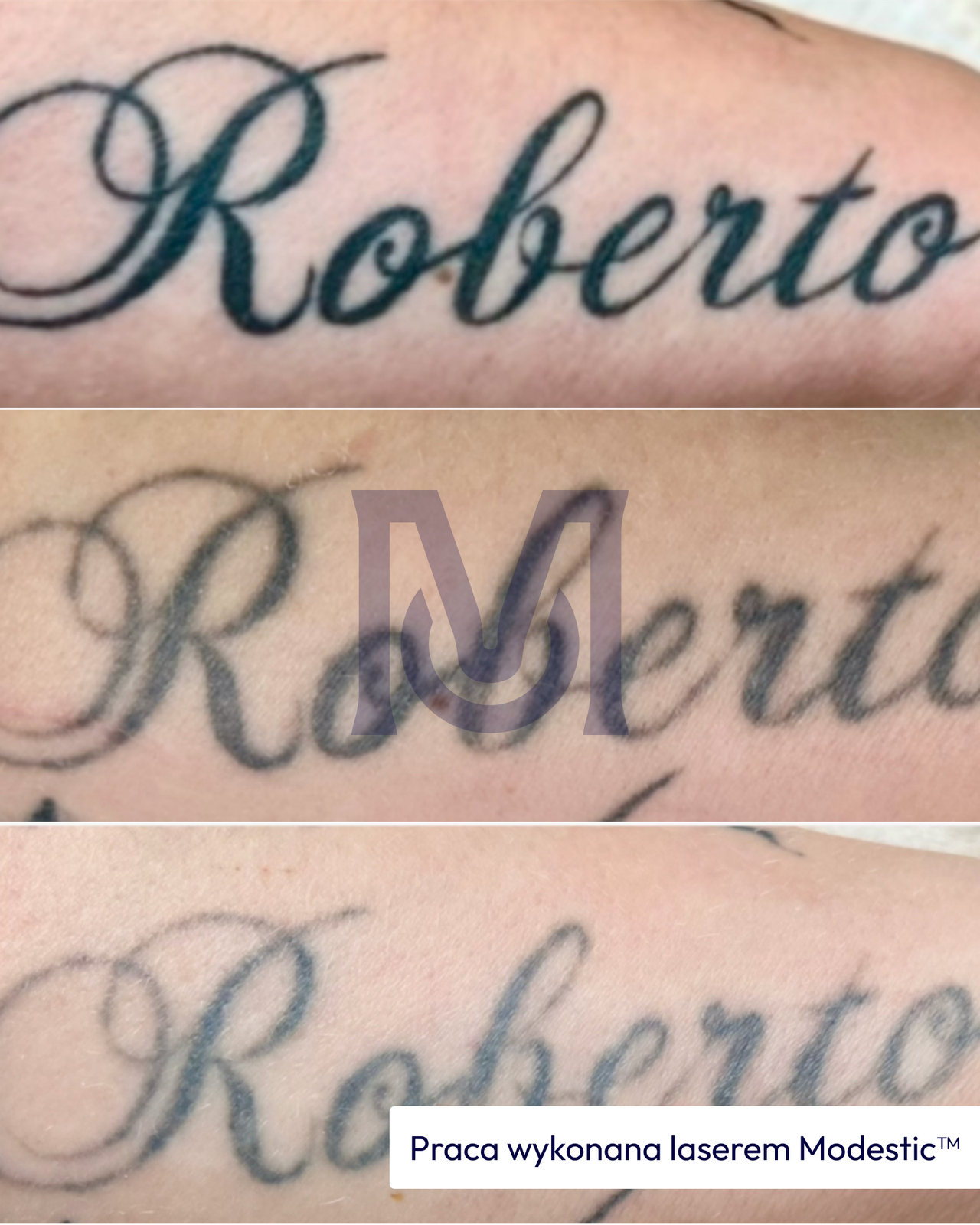 Efekt usuwania tatuażu napisu "Roberto" laserem Modestic – trzy etapy rozjaśniania pigmentu