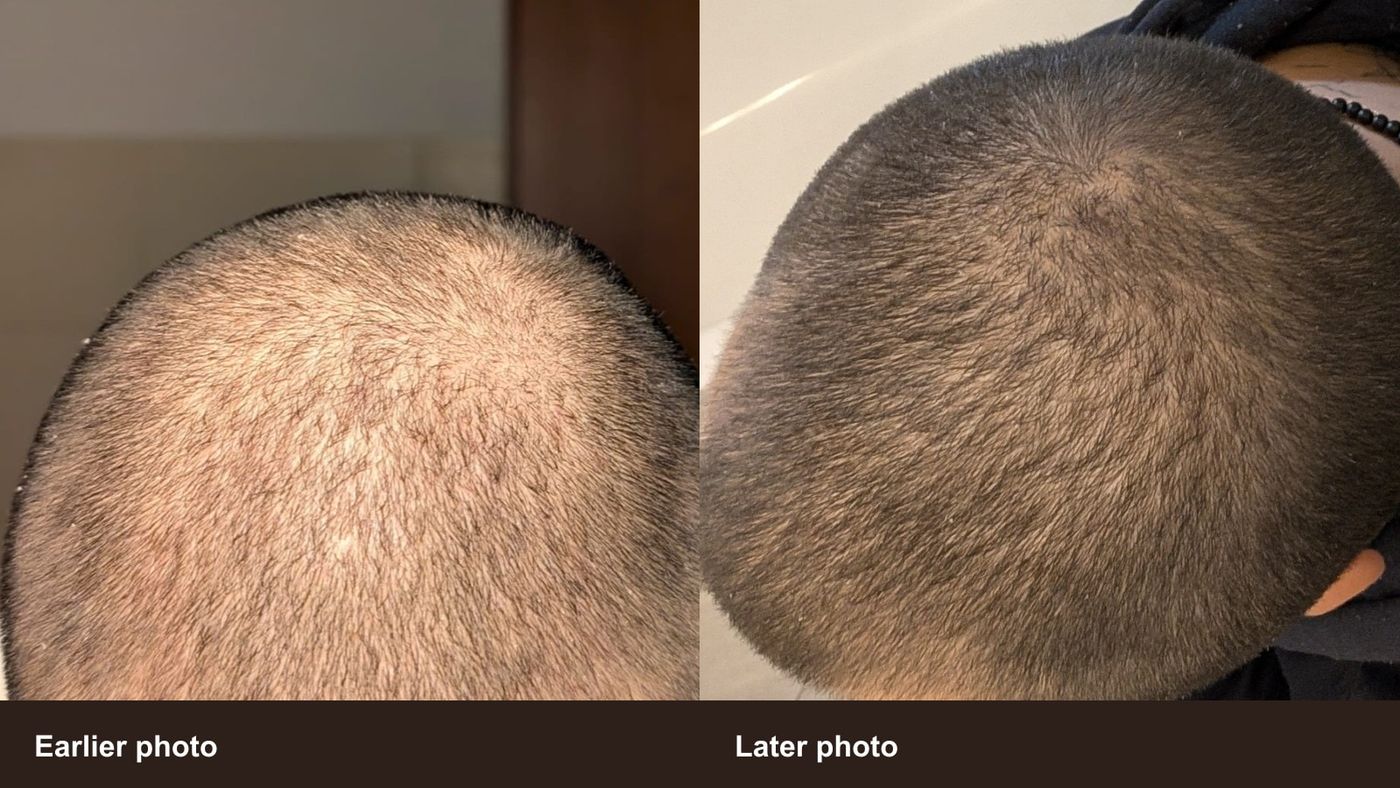 Two unretouched top-down crown photos from the founder's real hair tracking timeline: earlier photo on the left and later photo on the right
