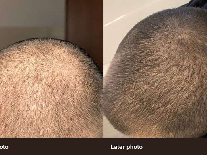 Two unretouched top-down crown photos from the founder's real hair tracking timeline: earlier photo on the left and later photo on the right