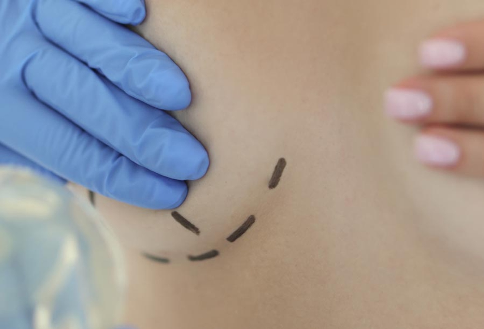 Breast with pre-surgery markings and blue glove covering them
