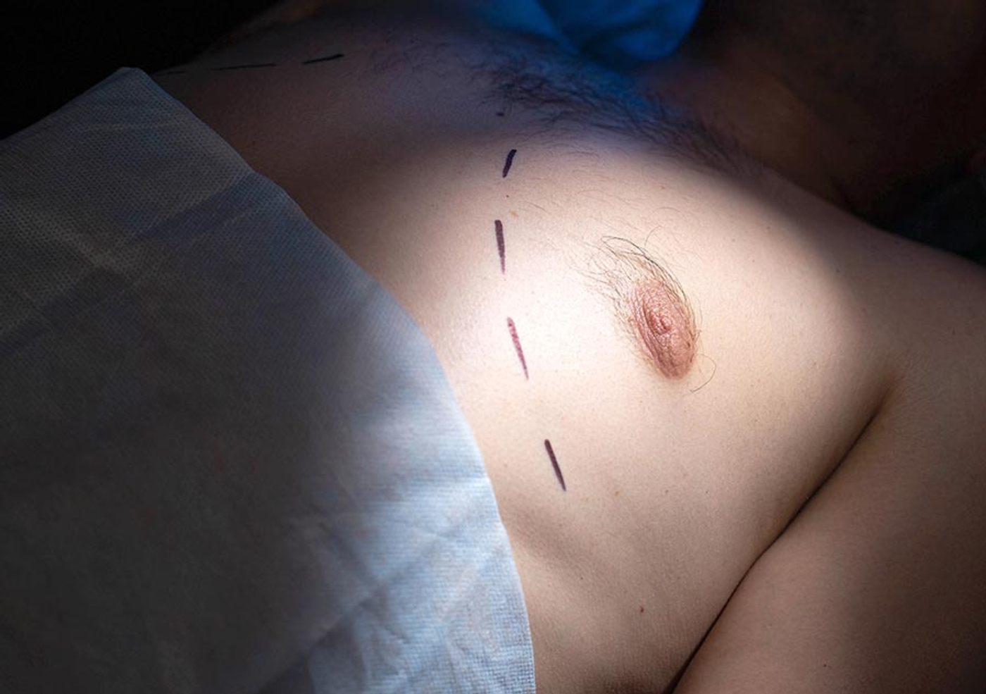 Male breast with pre-surgery markings