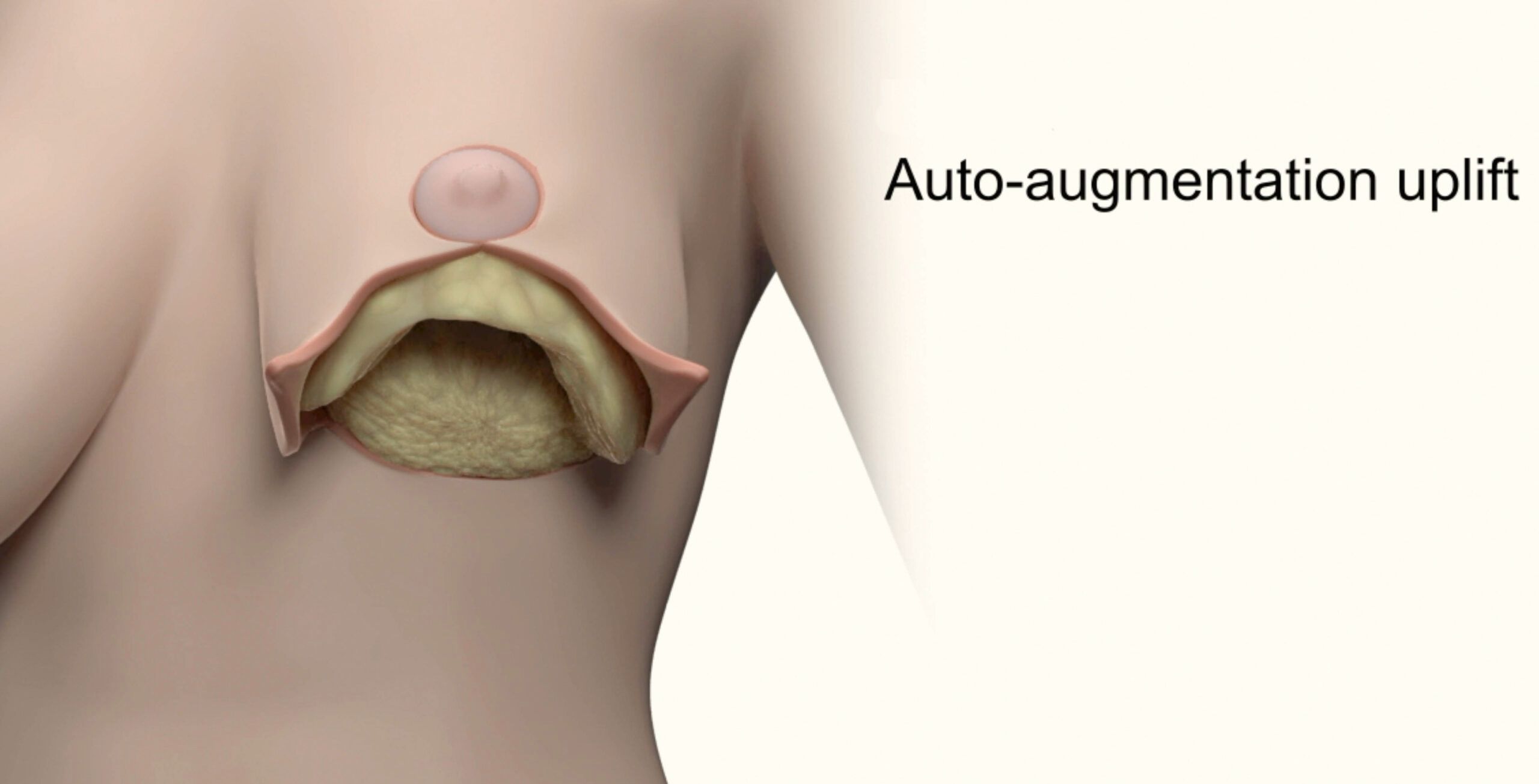 Computer generated graphic of a cross profile of a breast