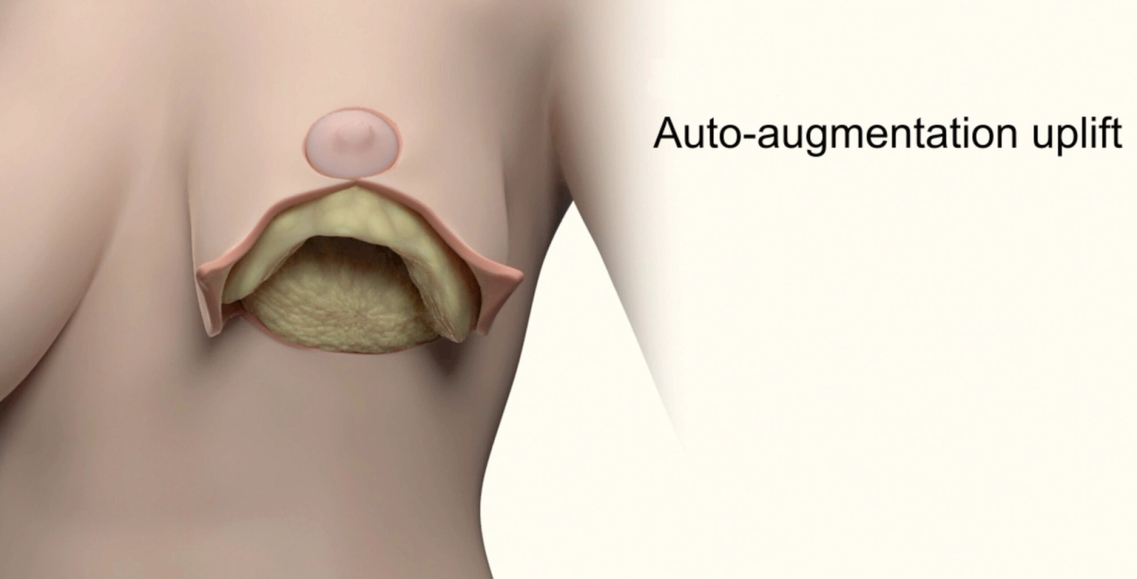 Computer generated graphic of a cross profile of a breast