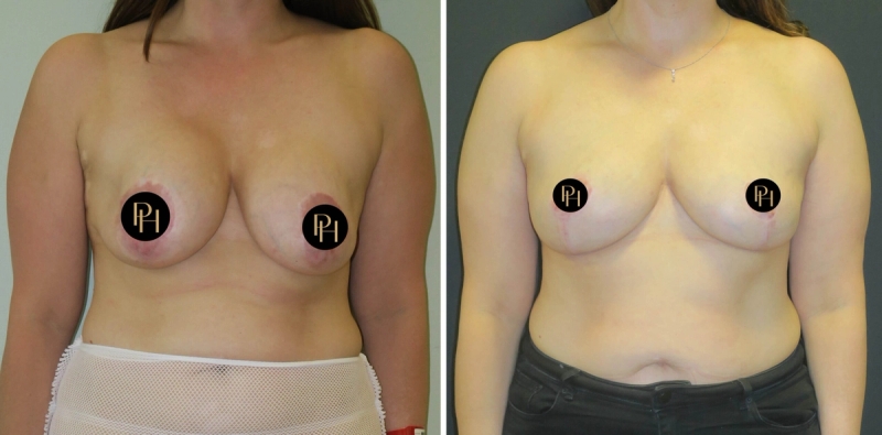Before and after image, following breast implant removal and auto augmentation