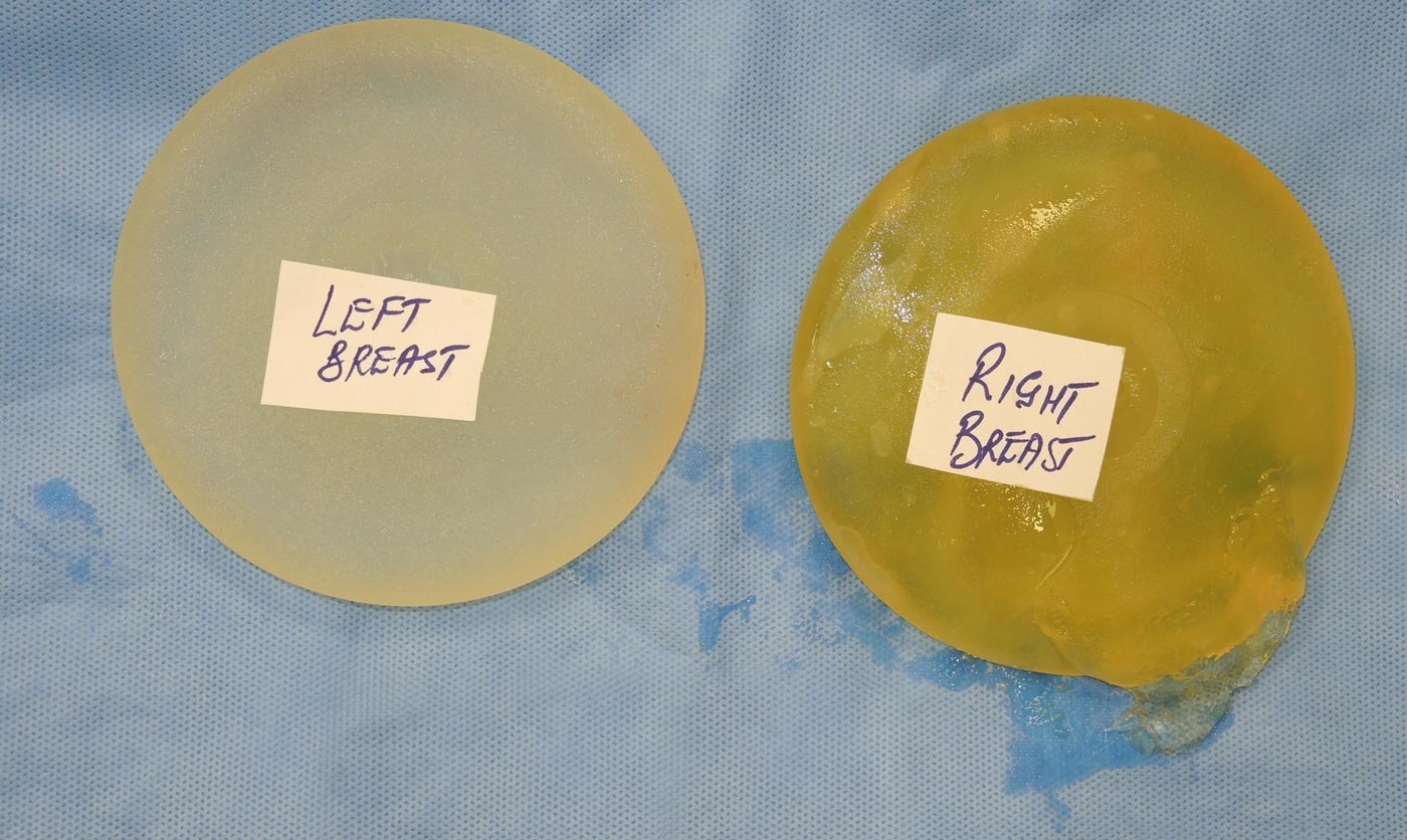 Two implants side-by-side