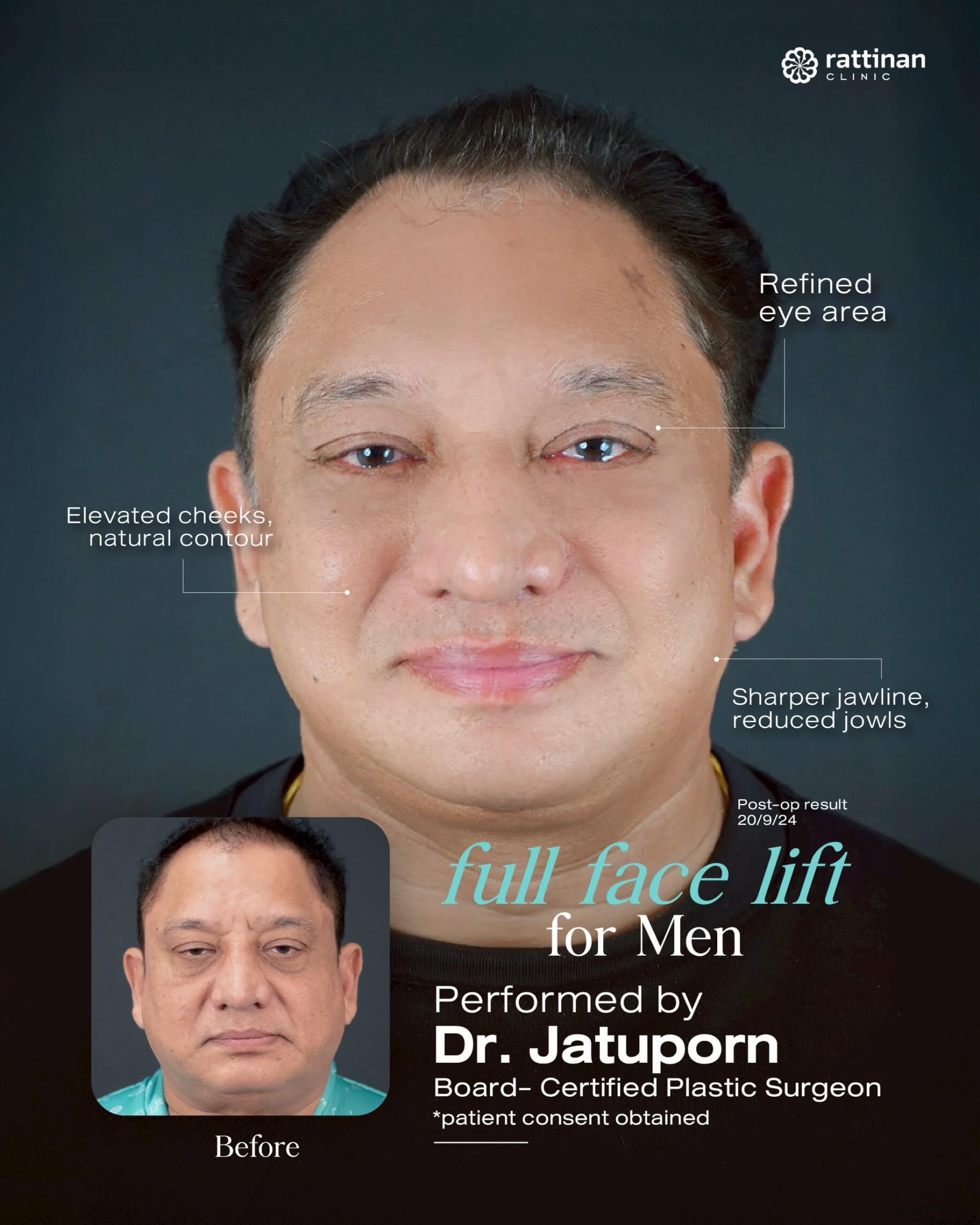 Before - after 2