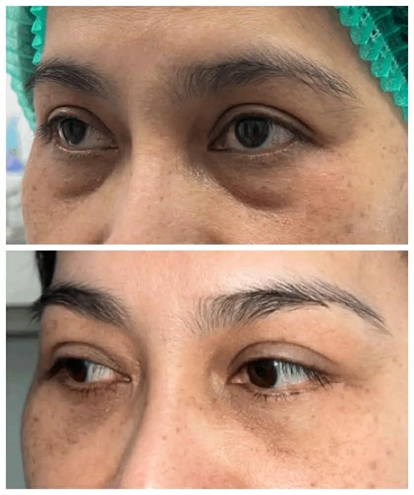Before - after 2