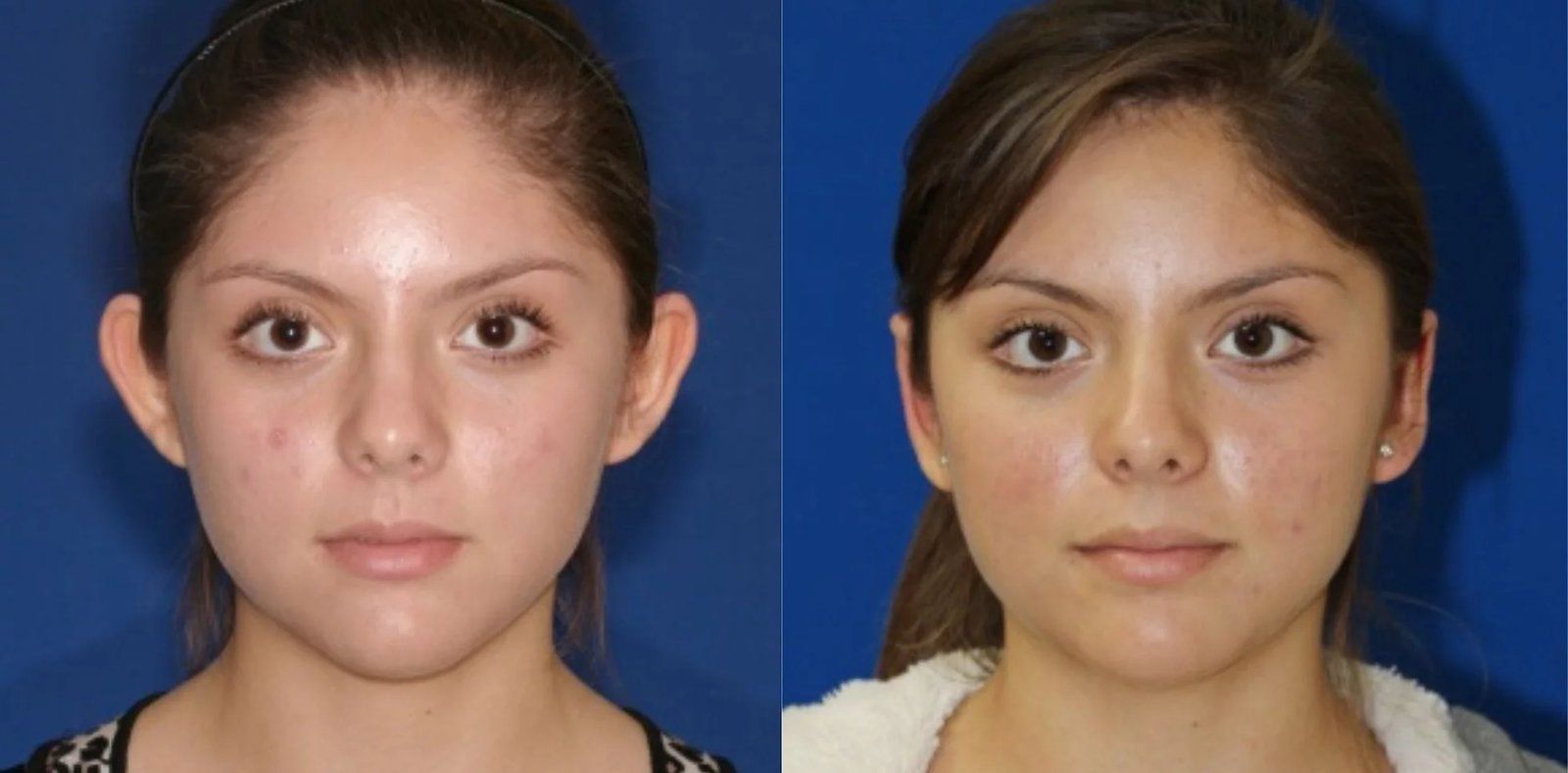 Ear Reshaping result 1