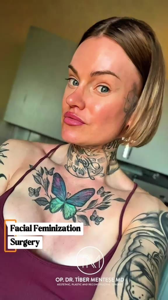 Facial Feminization Surgery Result — Dr. Tiber Menteşe