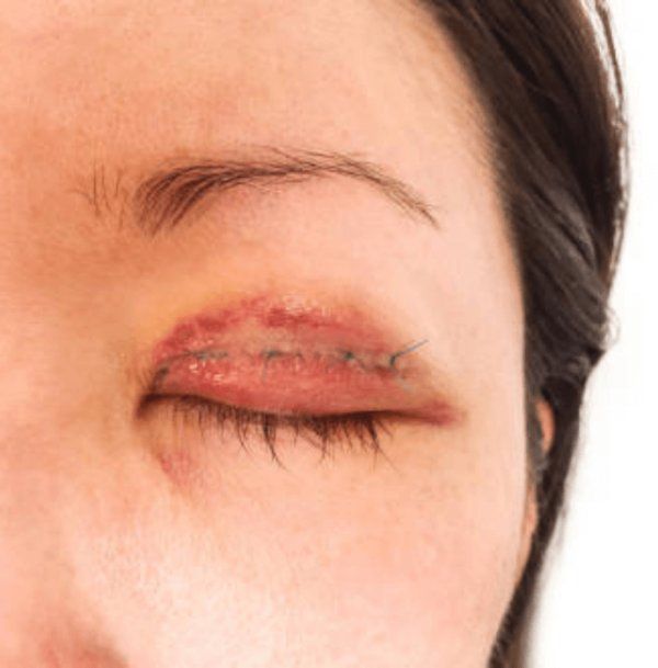 Blepharoplasty result 4