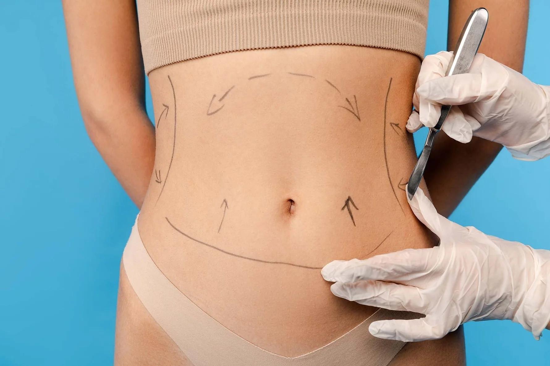 Mommy Makeover — Dr. Güleş