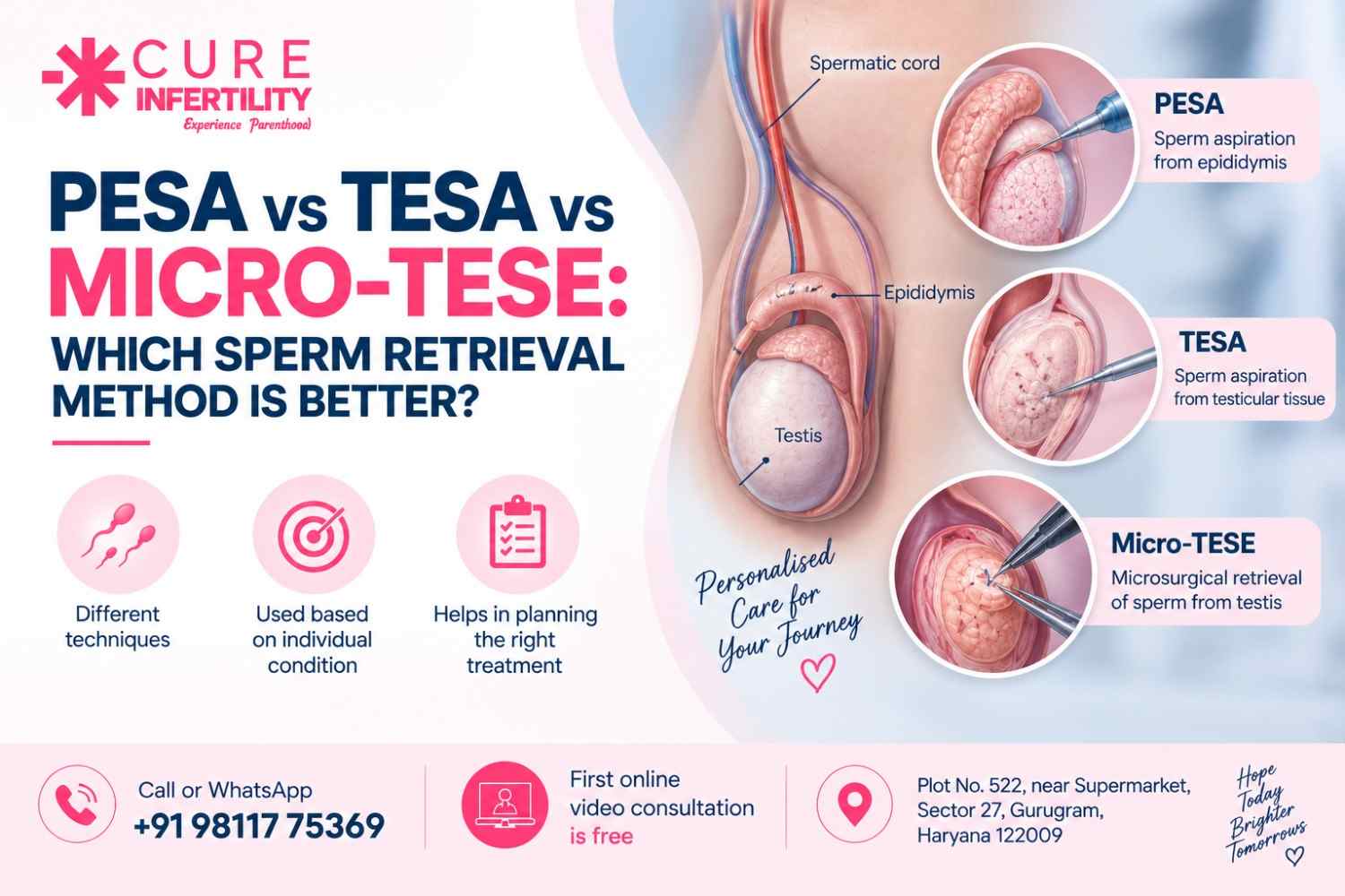PESA vs TESA vs Micro-TESE: Which Sperm Retrieval Method Is Better?