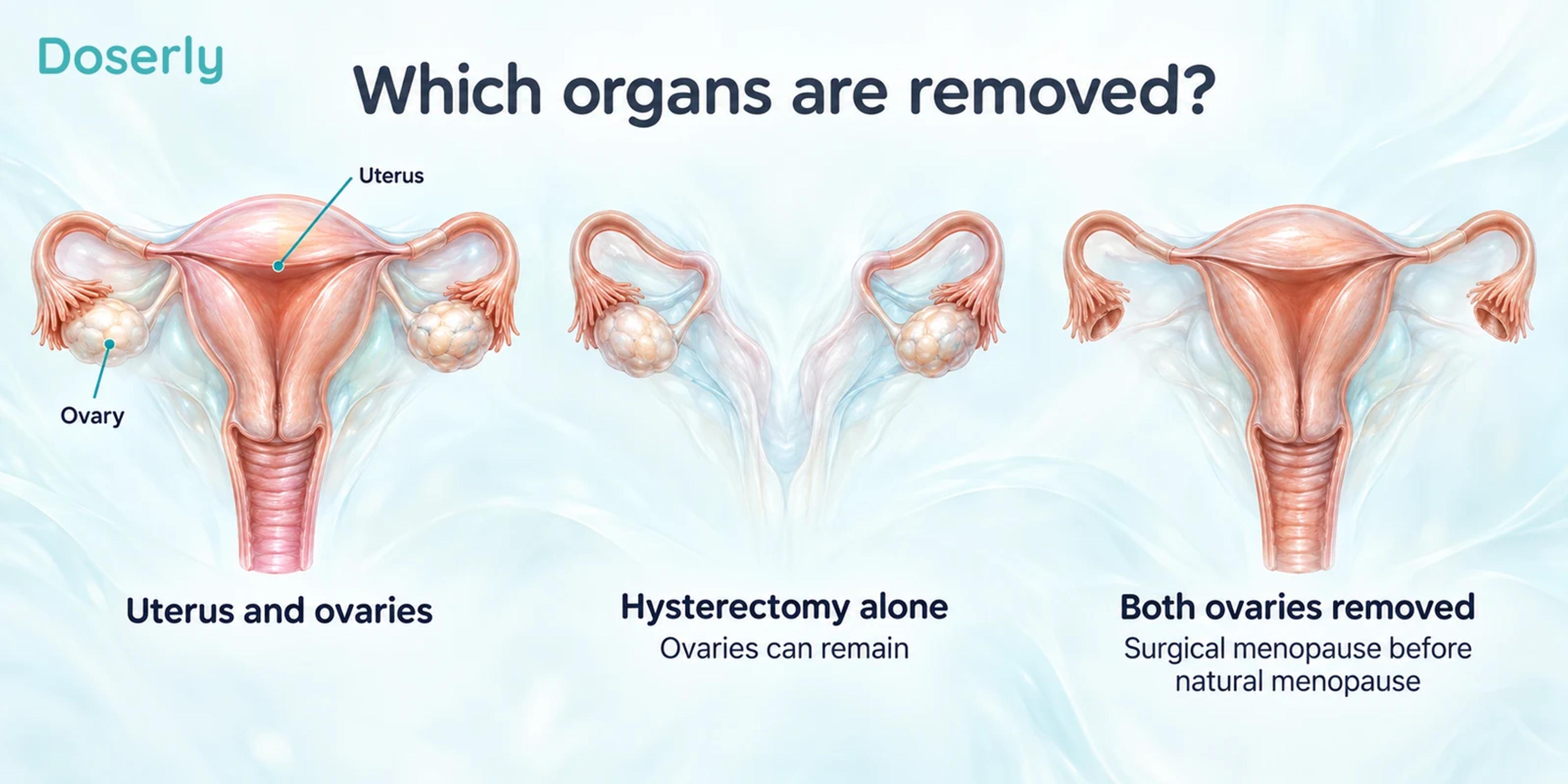 Anatomical comparison distinguishes the uterus and ovaries, hysterectomy with ovaries retained, and removal of both ovaries.