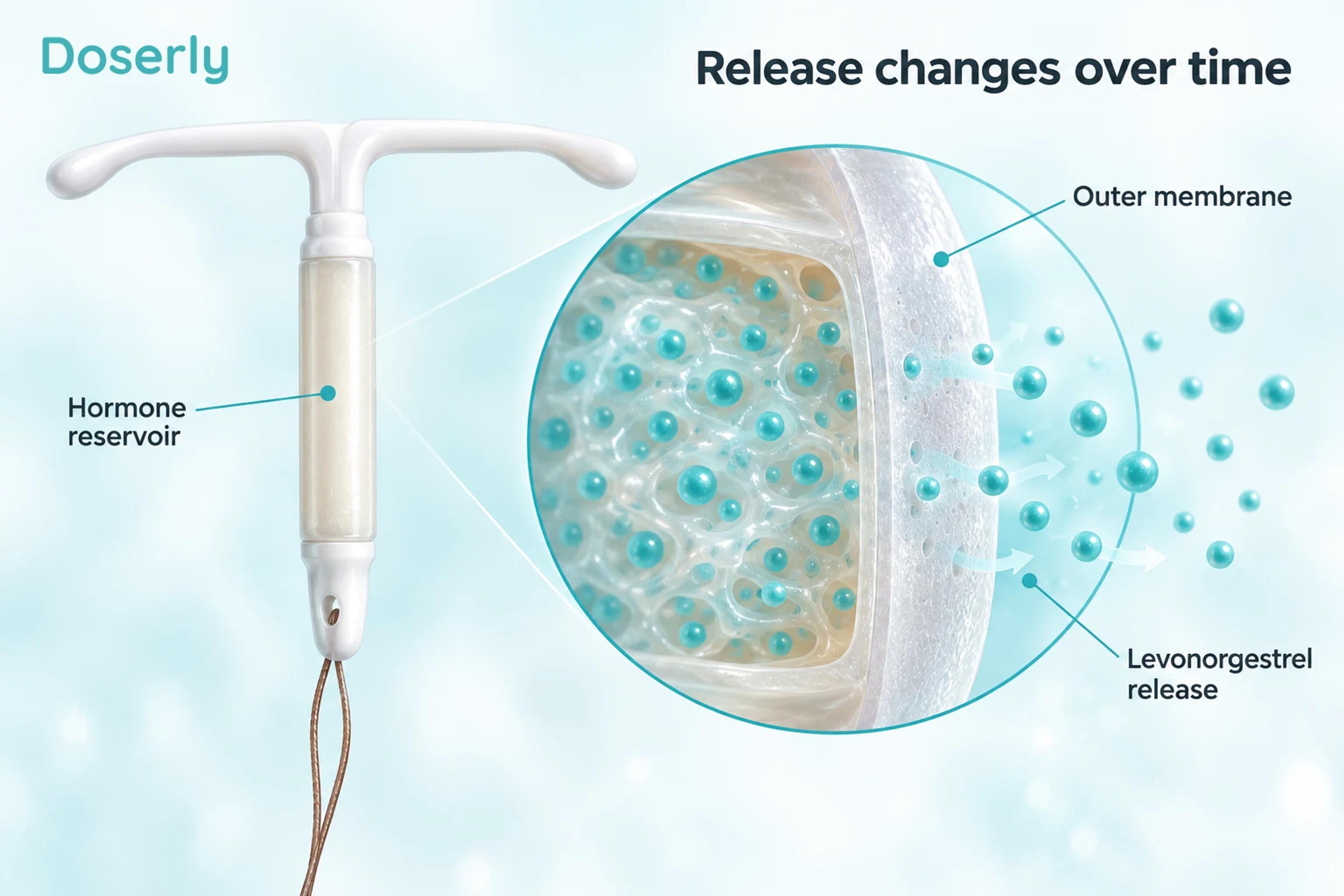 Hormonal IUD with an enlarged reservoir and membrane illustrating levonorgestrel release.